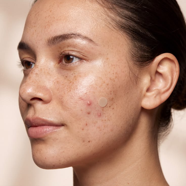 AcneOff™ Invisible Acne Patches — 144 Count