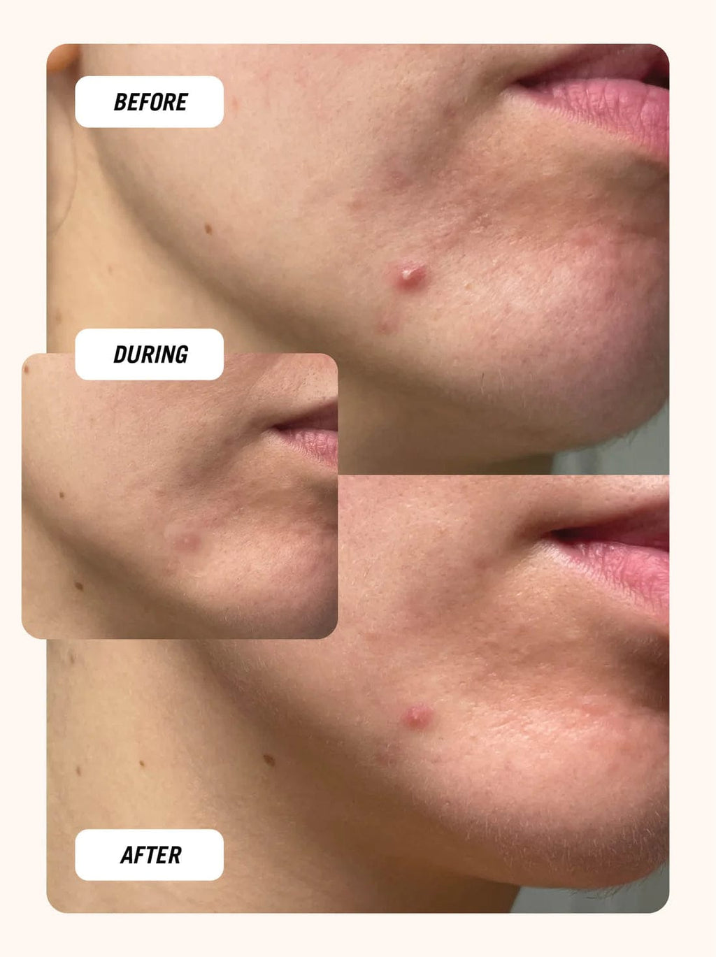 AcneOff™ Invisible Acne Patches — 144 Count